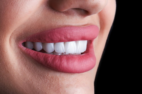 Porcelain veneer shells displayed with red lips demonstrating a cosmetic smile makeover result