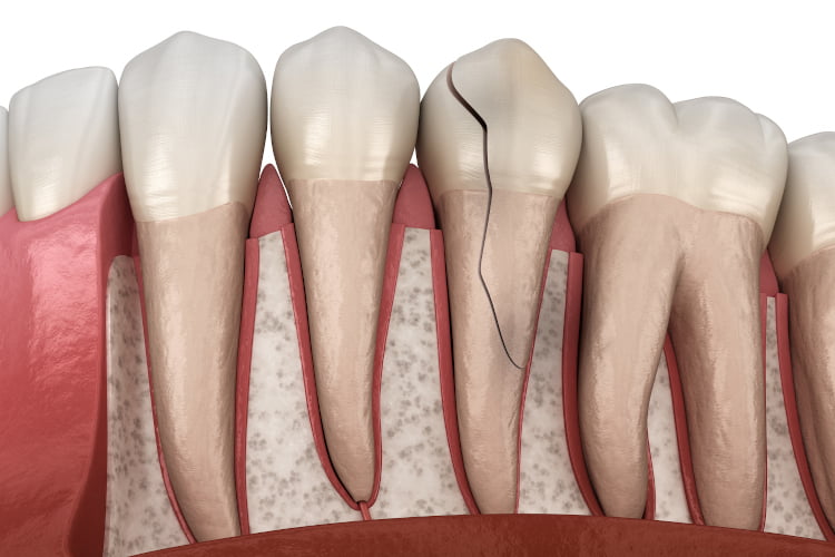 Treating a Chipped Tooth