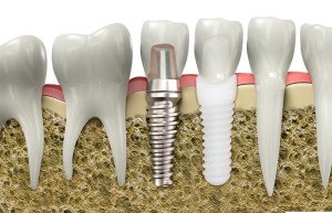 Metal-and-Ceramic-Dental-Implants-300x193.jpg