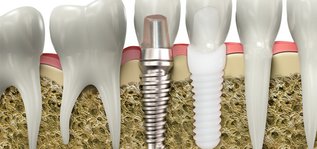 Metal-and-Ceramic-Dental-Implants-720x340.jpg