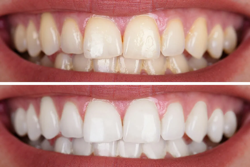 Professional Teeth Whitening.webp