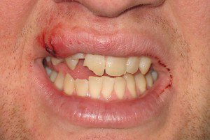 Tooth-Trauma-300x201.jpg