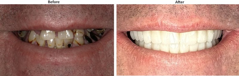 Before and after All-on-X full arch dental implants: severely decayed teeth replaced with a fixed implant-supported bridge