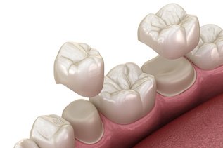Dental crowns placement over premolar and molar, restoring damaged teeth