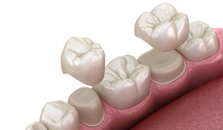 Dental crowns placement over premolar and molar, restoring damaged teeth