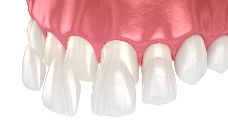 Digital intraoral scanner capturing impression for porcelain veneers