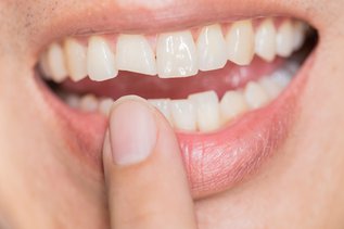 how to fix a broken tooth .jpeg