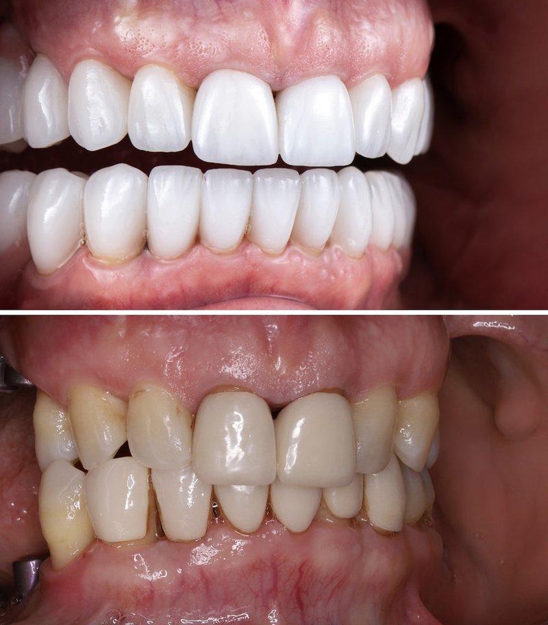 Close-up of patient smiling with new porcelain veneers
