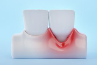 Illustration showing gingival recession with exposed tooth roots caused by receding gums