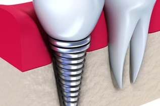 same_day_implants-720x340.jpg