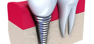 same_day_implants-720x340.jpg