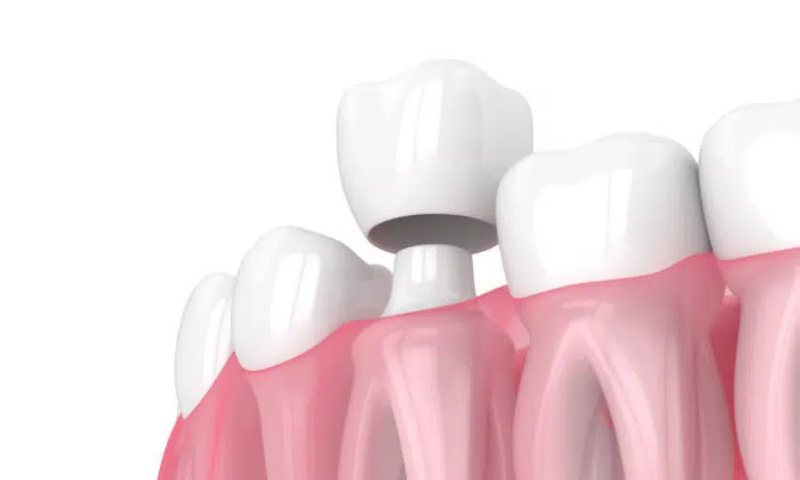 tooth crowns.webp