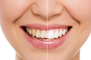 Woman smiling after dental treatment, comparing veneers vs teeth whitening results
